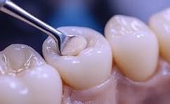 Tooth Fillings